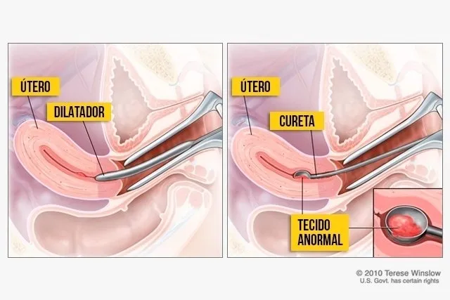 como é realizado curetagem e procedimento cirurgico para aborto