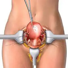 histerectomia, retirada do utero