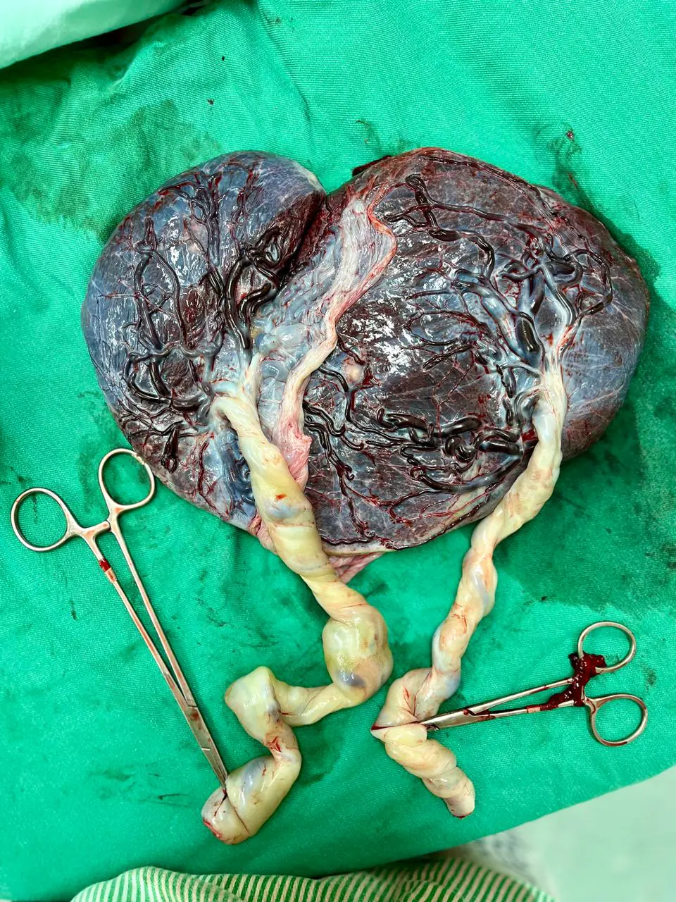 Placenta de gestação gemelar monocorionica-diamniotica; placenta de gemeos