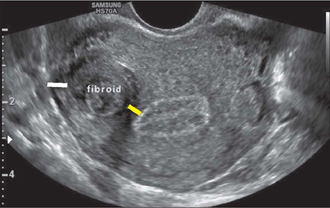 ultrassom de mioma, utero com mioma