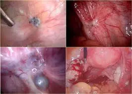 Cirurgia para endometriose.